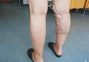 Κιρσοί φλεβικο συστημα