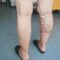 Κιρσοί φλεβικο συστημα
