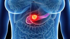 ΚΑΡΚΙΝΟΣ_ΠΑΓΚΡΕΑΣ_ilovepatrida