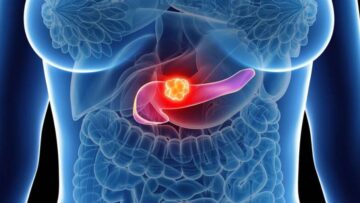 ΚΑΡΚΙΝΟΣ_ΠΑΓΚΡΕΑΣ_ilovepatrida